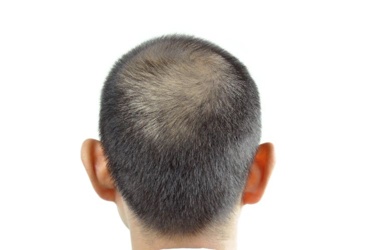 Sempre più uomini si sottopongono alle nuove tecniche di trapianto capelli